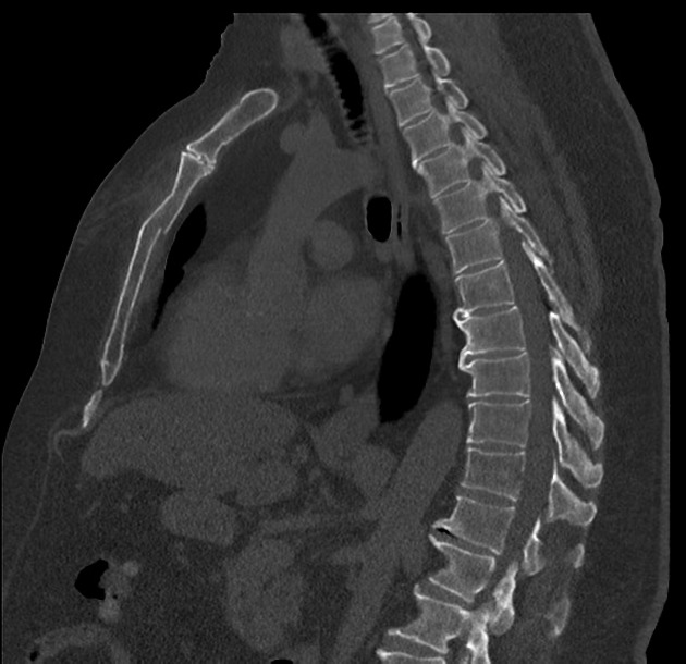 Detail Gambar Radiologi Trauma Sternum Nomer 7