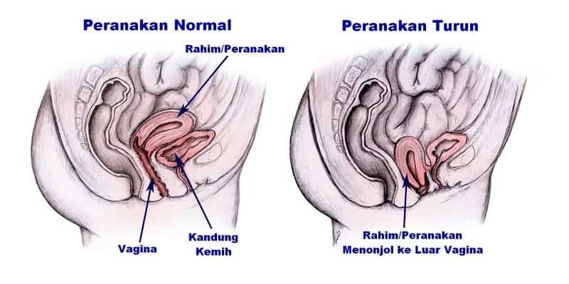 Detail Gambar Rahim Turun Nomer 20