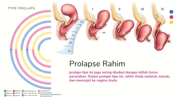 Detail Gambar Rahim Turun Nomer 23