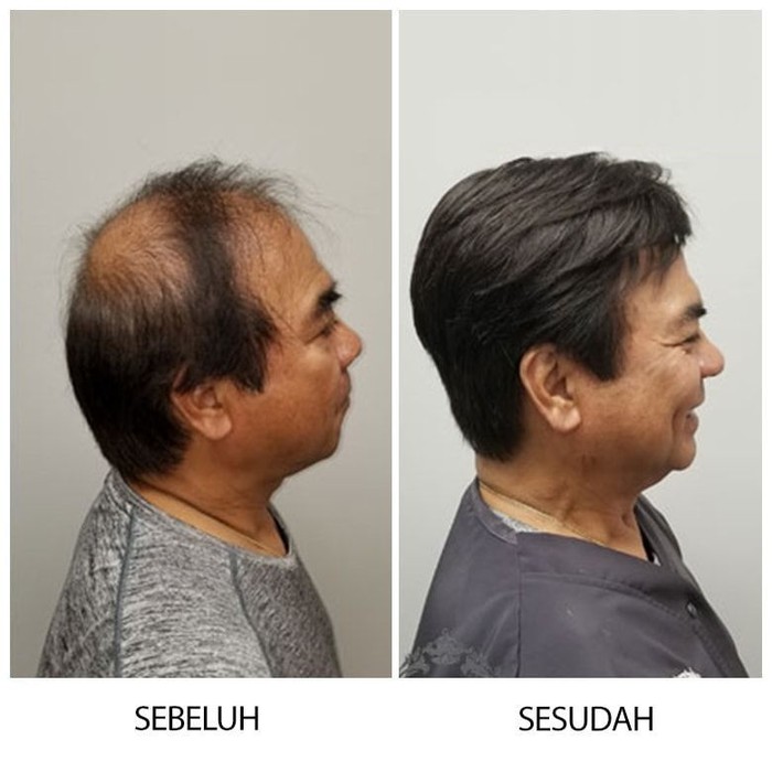 Detail Gambar Rambut Botak Nomer 26