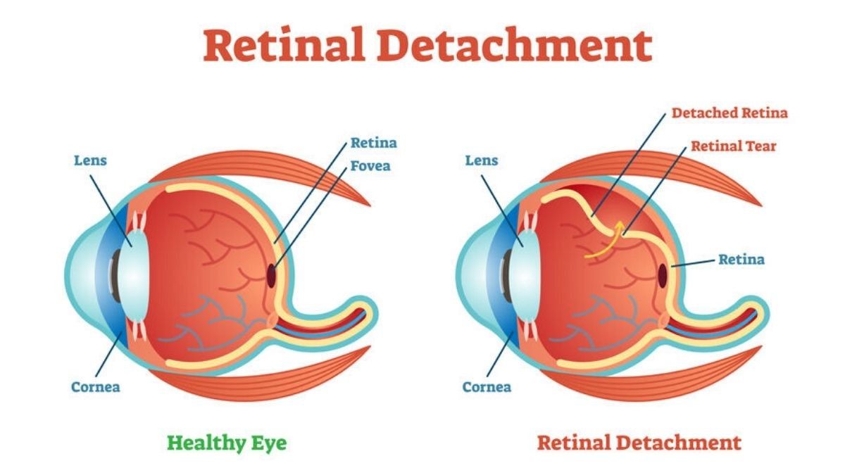 Detail Gambar Retina Mata Nomer 2