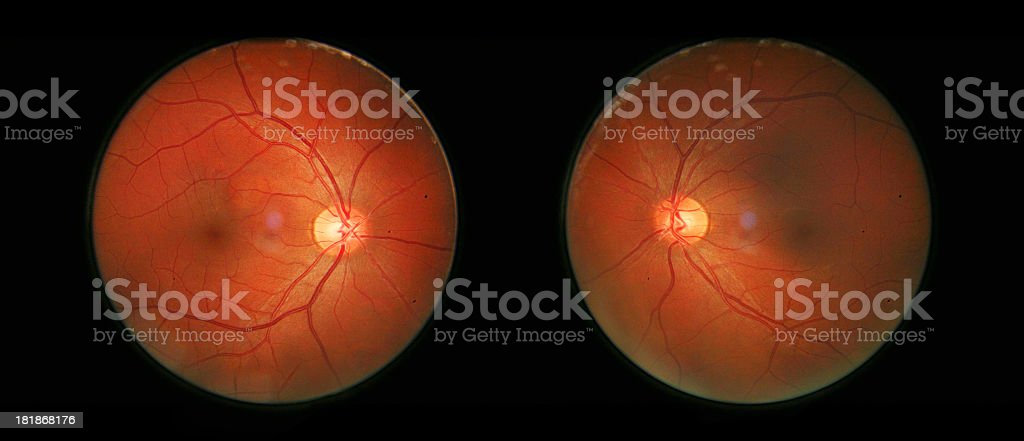 Detail Gambar Retina Mata Nomer 34