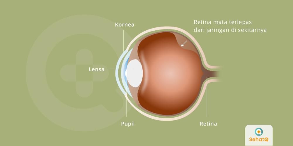 Detail Gambar Retina Mata Nomer 35