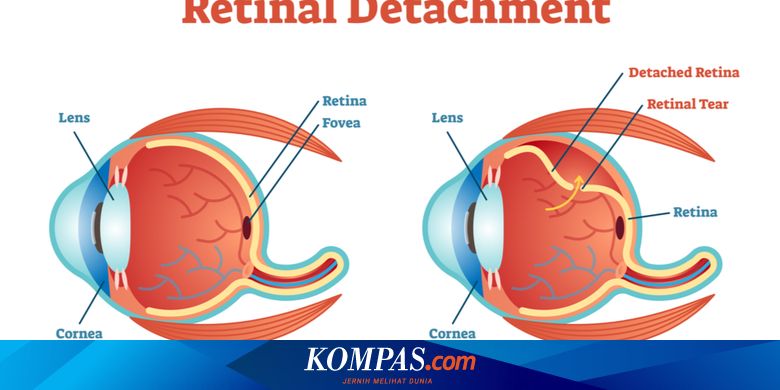 Detail Gambar Retina Mata Lepas Nomer 12