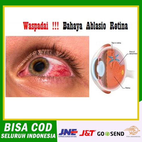 Detail Gambar Retina Mata Lepas Nomer 10