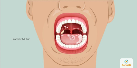 Detail Gambar Rongga Mulut Yang Sehat Nomer 9