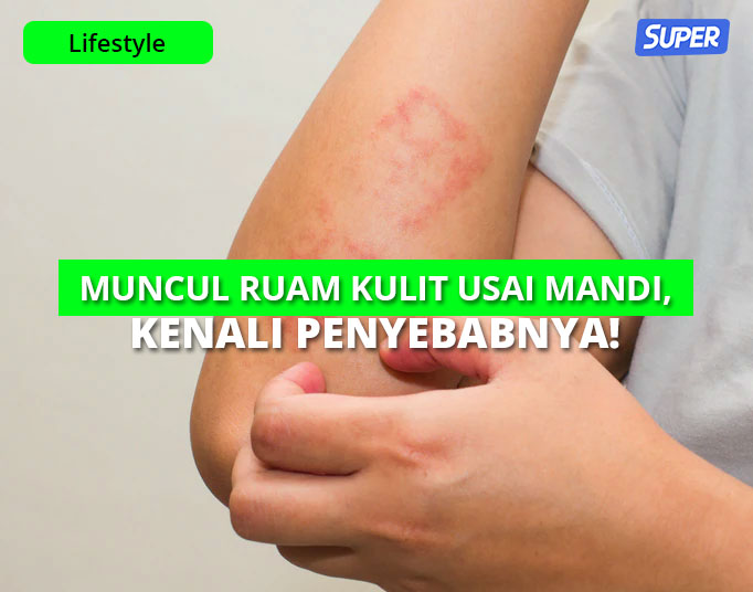 Detail Gambar Ruam Kulit Hiv Nomer 48