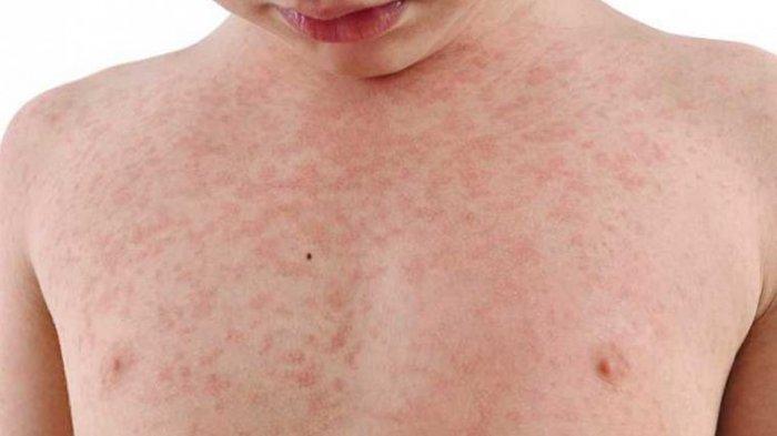 Download Gambar Rubella Dalam Kehamilan Nomer 48