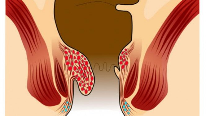 Detail Gambar Sakit Ambeien Nomer 12