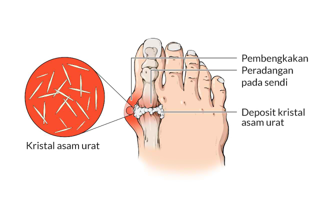 Detail Gambar Sakit Gout Nomer 2