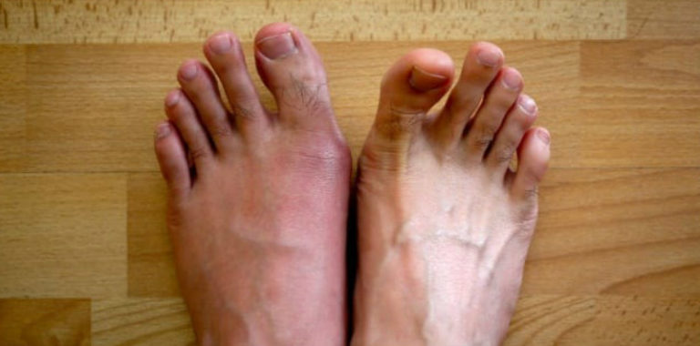 Detail Gambar Sakit Gout Nomer 12