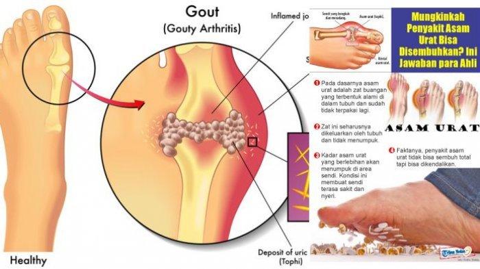 Detail Gambar Sakit Gout Nomer 14