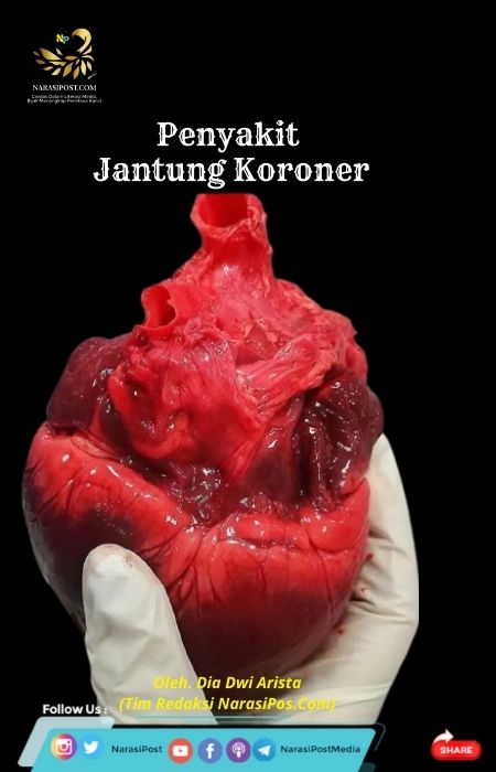 Detail Gambar Sakit Jantung Koroner Nomer 24
