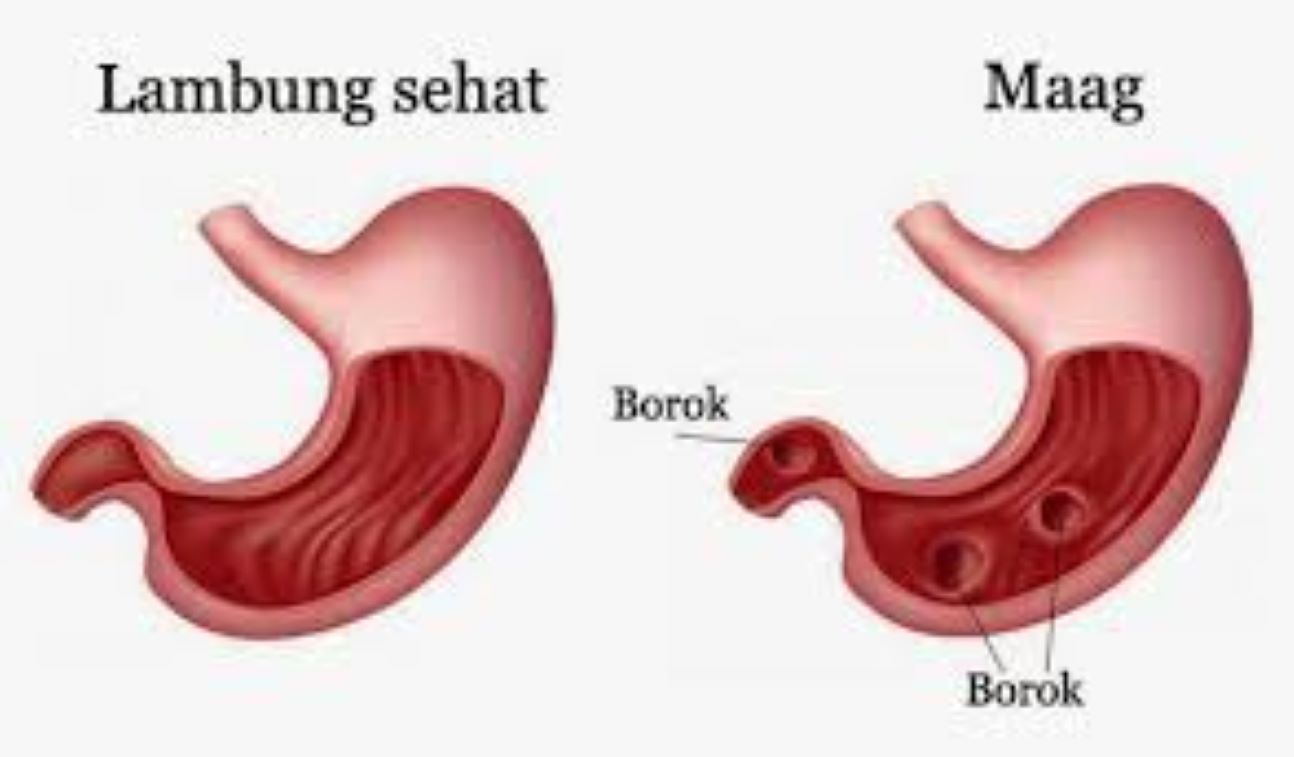 Detail Gambar Sakit Maag Kambuh Nomer 18