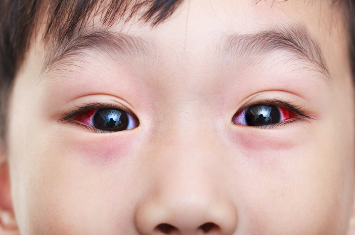 Detail Gambar Sakit Mata Pada Anak Nomer 21