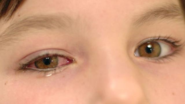 Detail Gambar Sakit Mata Pada Anak Nomer 6