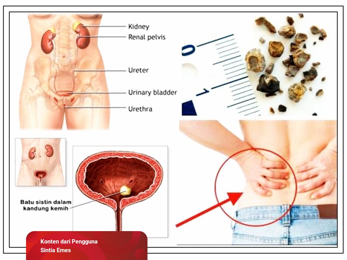 Detail Gambar Saluran Kemih Nomer 46
