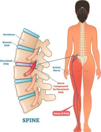 Gambar Saraf Tulang Belakang Terjepit - KibrisPDR