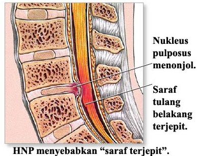 Detail Gambar Saraf Tulang Belakang Terjepit Nomer 15