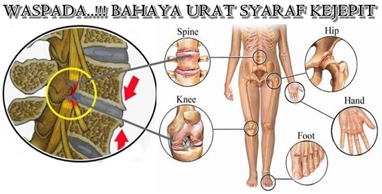 Detail Gambar Saraf Tulang Belakang Terjepit Nomer 40