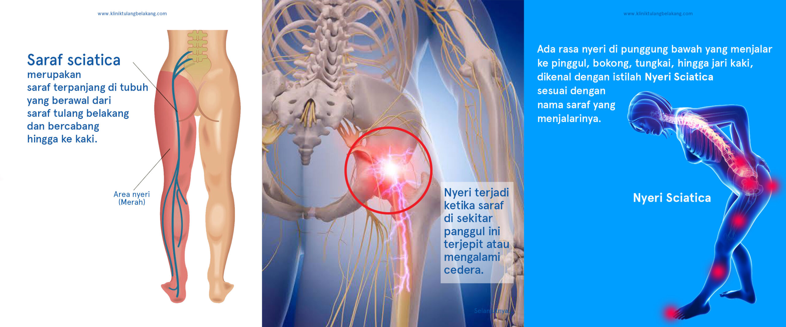 Detail Gambar Saraf Tulang Belakang Terjepit Nomer 52