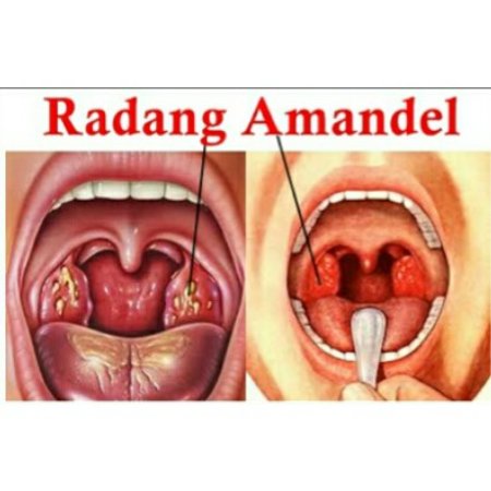 Detail Gambar Sariawan Di Tenggorokan Nomer 18