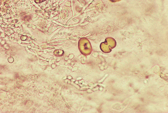 Detail Gambar Sedimen Urin Nomer 15