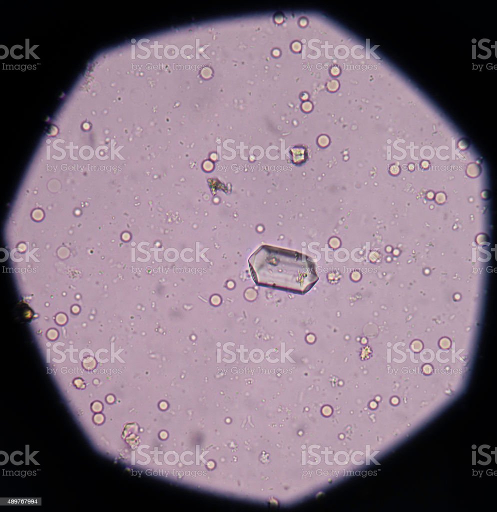 Detail Gambar Sedimen Urin Nomer 24