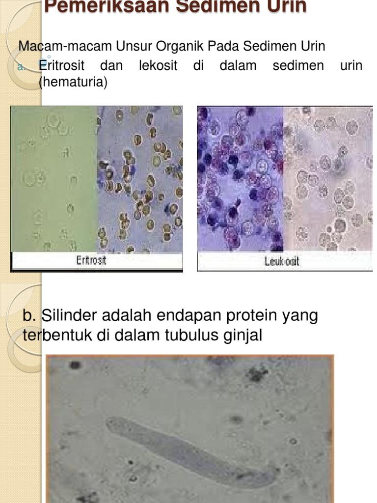 Detail Gambar Sedimen Urin Nomer 39