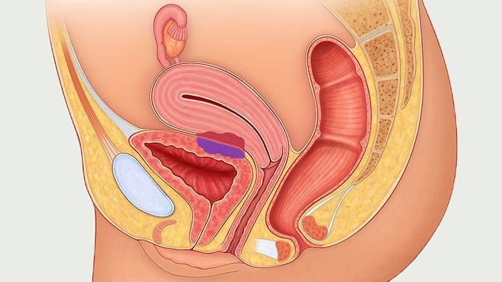 Detail Gambar Selaput Dara Robek Karena Jari Nomer 42