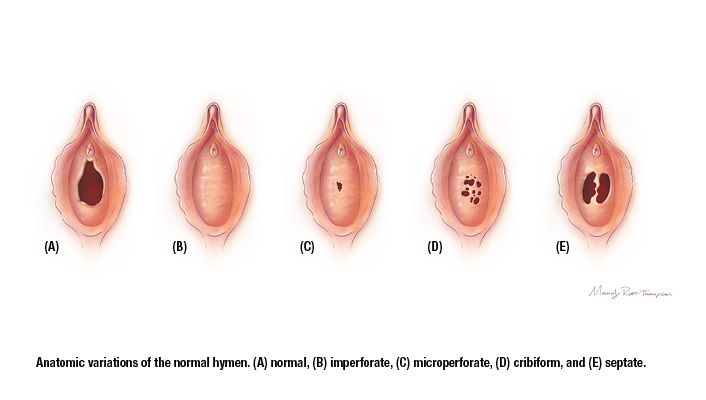 Detail Gambar Selaput Dara Wanita Nomer 10