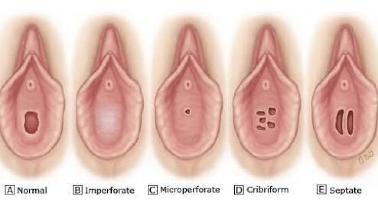 Detail Gambar Selaput Dara Wanita Nomer 3