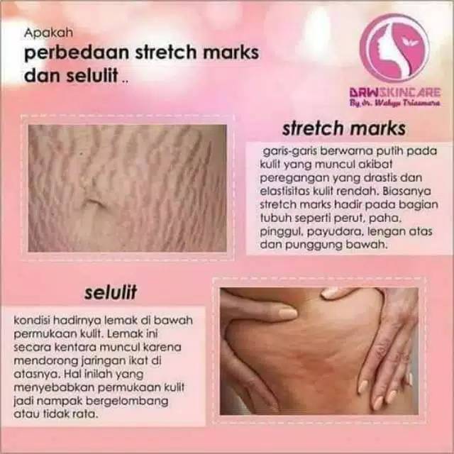 Detail Gambar Selulit Dan Stretch Mark Nomer 16