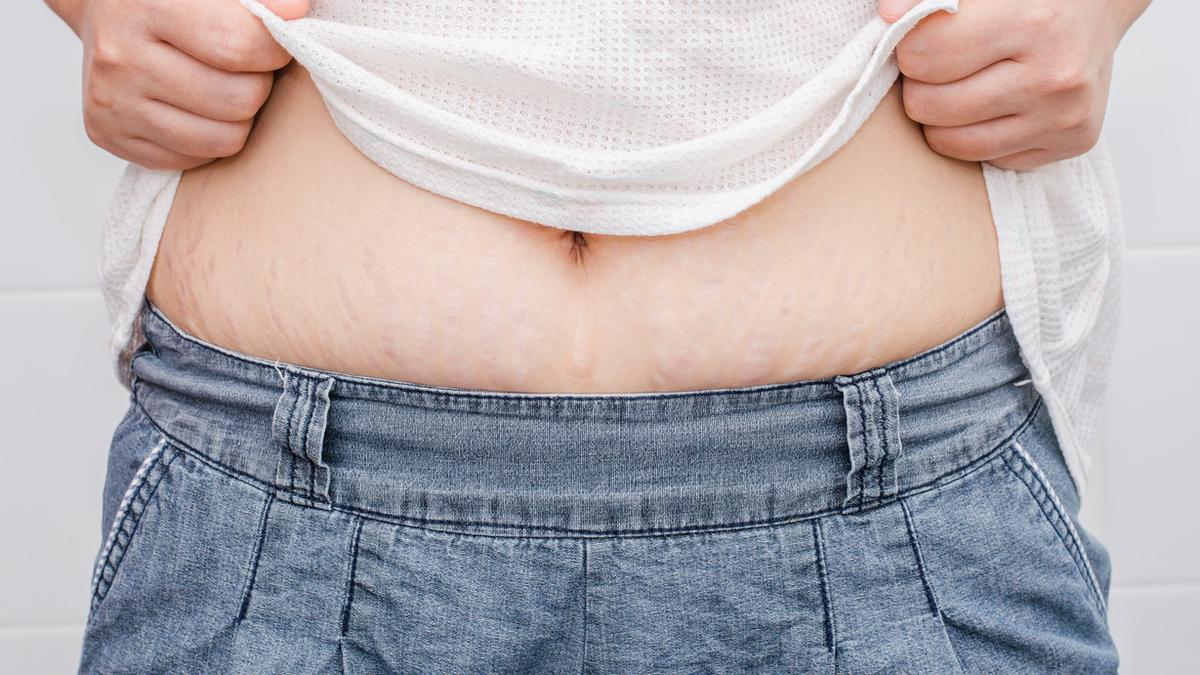 Detail Gambar Selulit Dan Stretch Mark Nomer 18