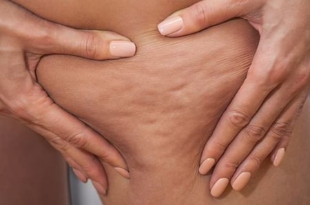 Detail Gambar Selulit Dan Stretch Mark Nomer 19