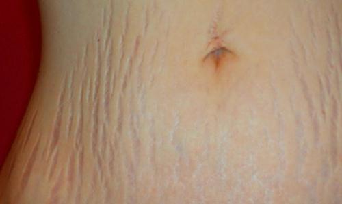 Detail Gambar Selulit Dan Stretch Mark Nomer 21