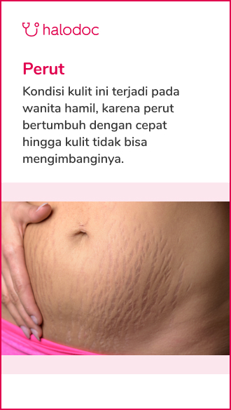 Detail Gambar Selulit Dan Stretch Mark Nomer 49