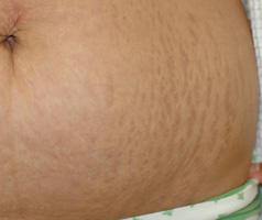 Detail Gambar Selulit Dan Stretch Mark Nomer 52