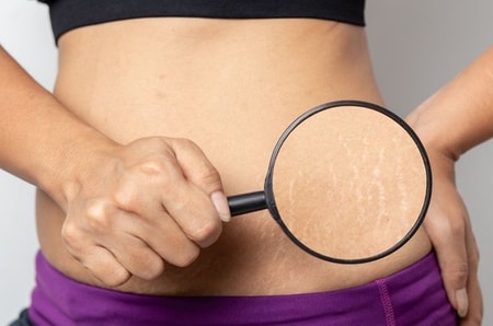 Detail Gambar Selulit Dan Stretch Mark Nomer 54