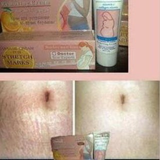 Detail Gambar Selulit Dan Stretch Mark Nomer 56