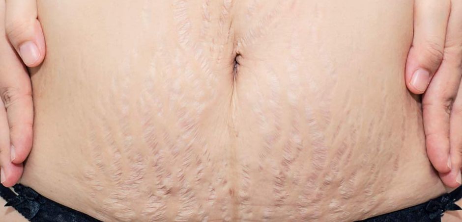 Detail Gambar Selulit Dan Stretch Mark Nomer 7