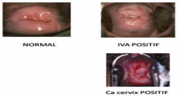 Detail Gambar Serviks Yg Sehat Nomer 6