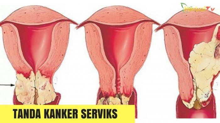 Detail Gambar Serviks Yg Sehat Nomer 10