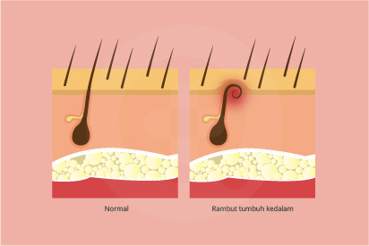 Detail Gambar Siklus Pertumbuhan Rambut Nomer 42