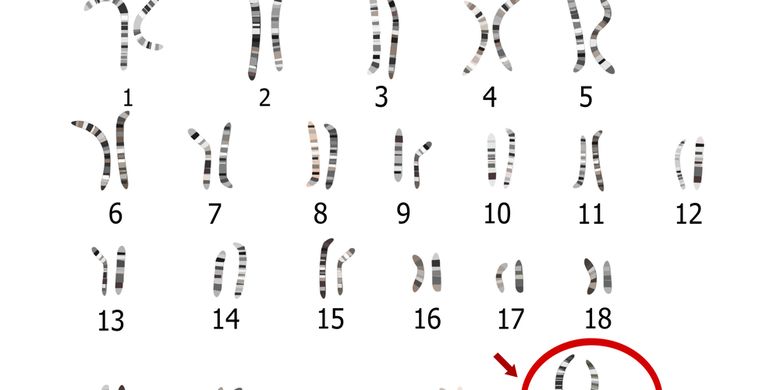 Detail Gambar Sindrom Edwars Nomer 20