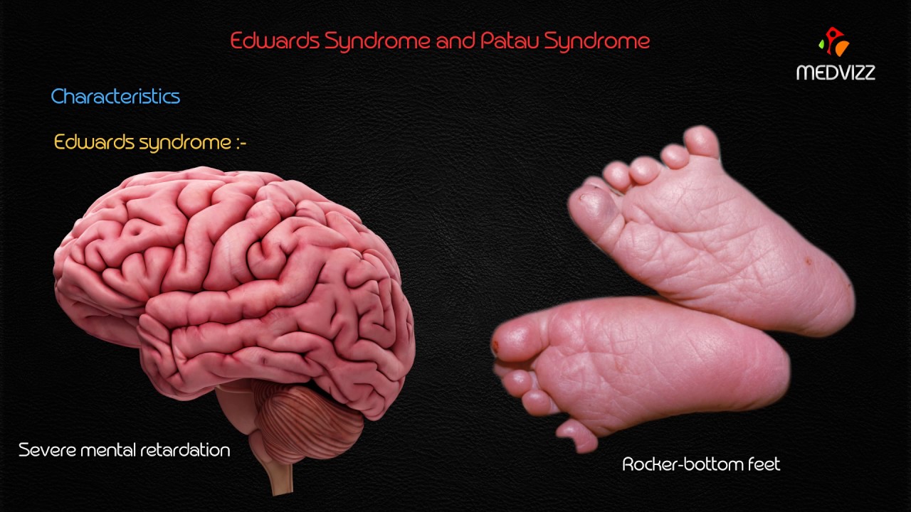 Detail Gambar Sindrom Edwars Nomer 53