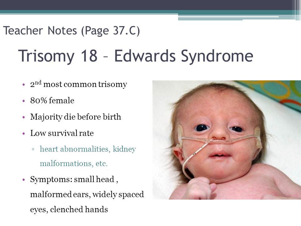 Detail Gambar Sindrom Edwars Nomer 7