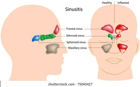 Detail Gambar Sinus Paranasal Nomer 42