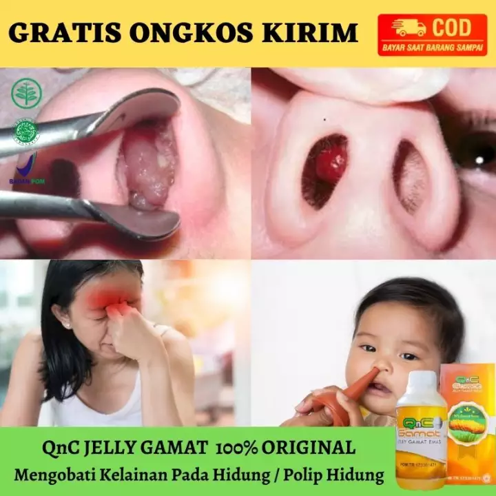 Detail Gambar Sinusitis Pada Hidung Nomer 48