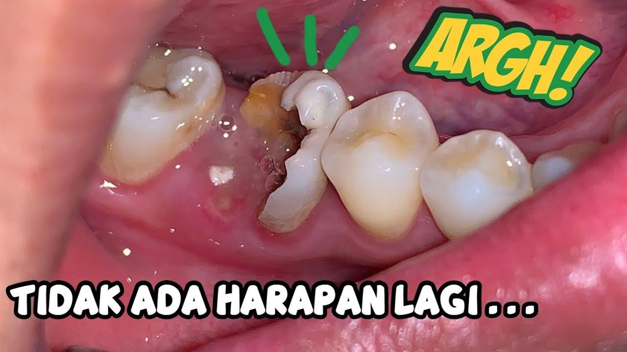 Detail Gambar Sisa Akar Gigi Permanen Rahang Atas Nomer 49